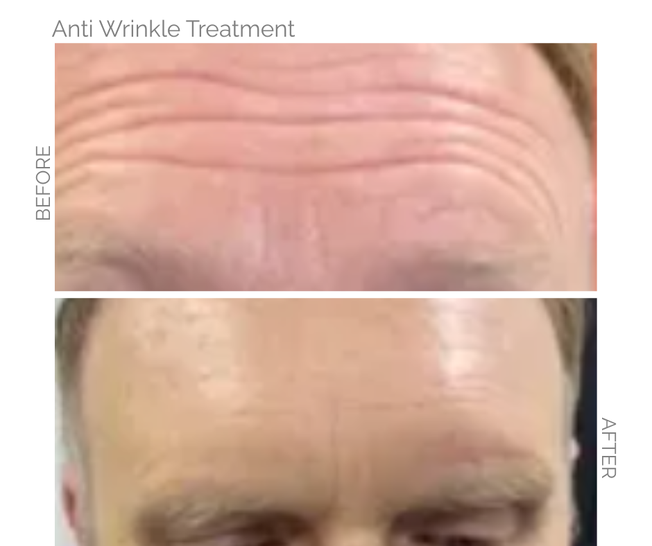 Forehead wrinkles before and after anti-wrinkle treatment; smoother skin in after photo.