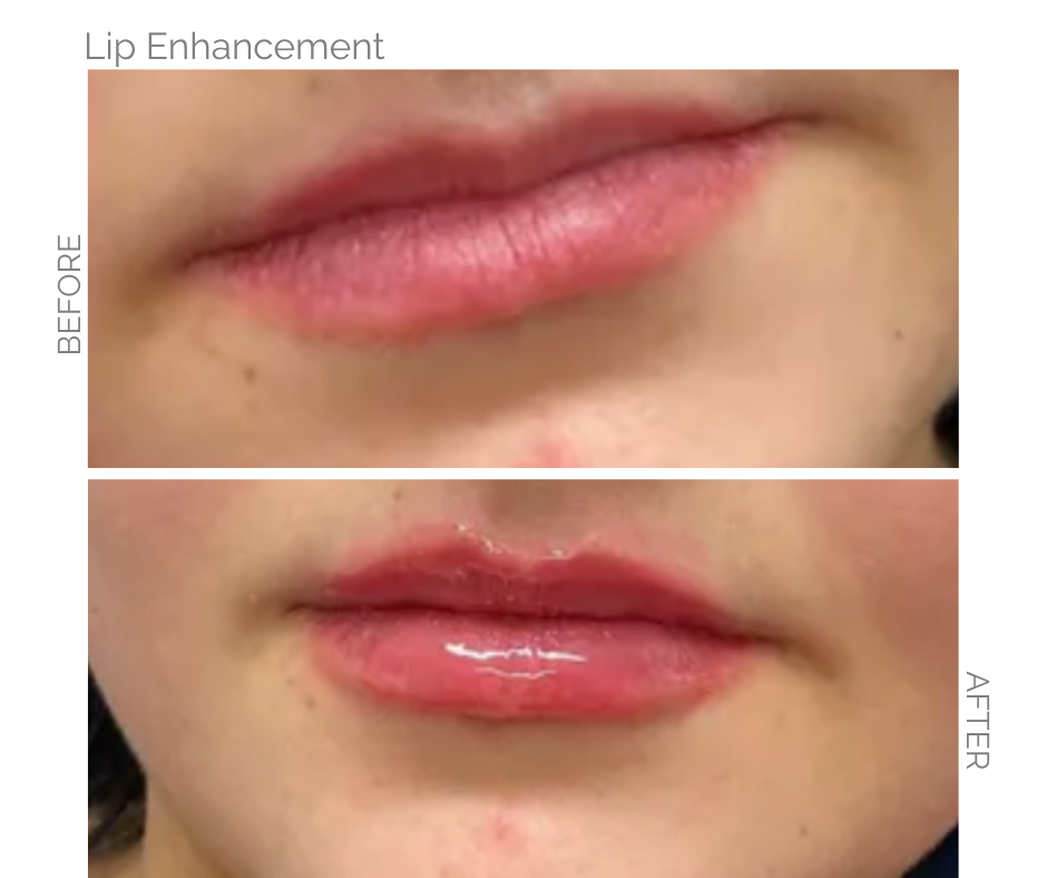 Lip enhancement comparison: Before, thin lips. After, fuller, shiny lips.
