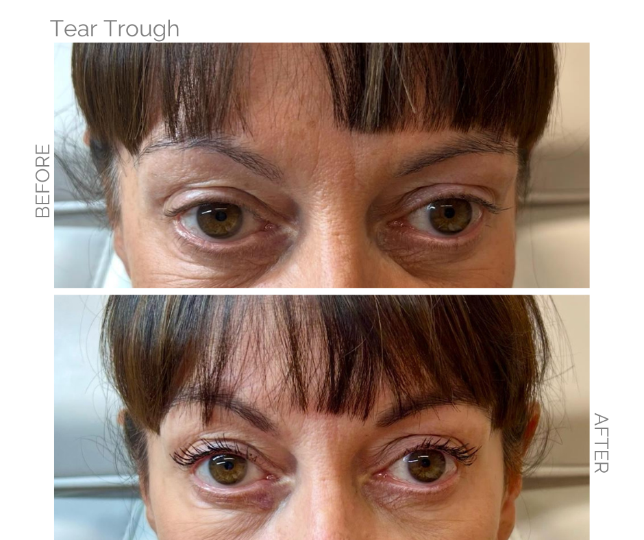Before and after Tear Trough on woman in Norwich