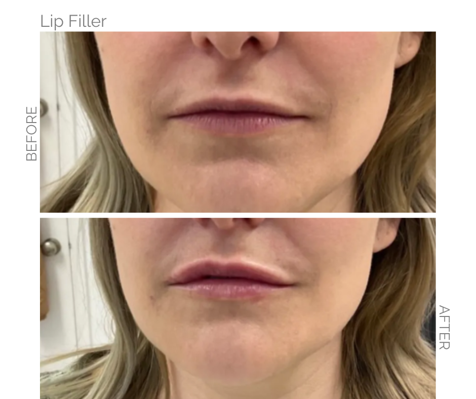 Lip Filler Before and After