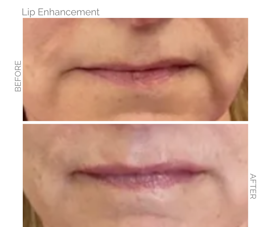 Before and after photos of lip enhancement: upper lips appear fuller after the procedure and more even.