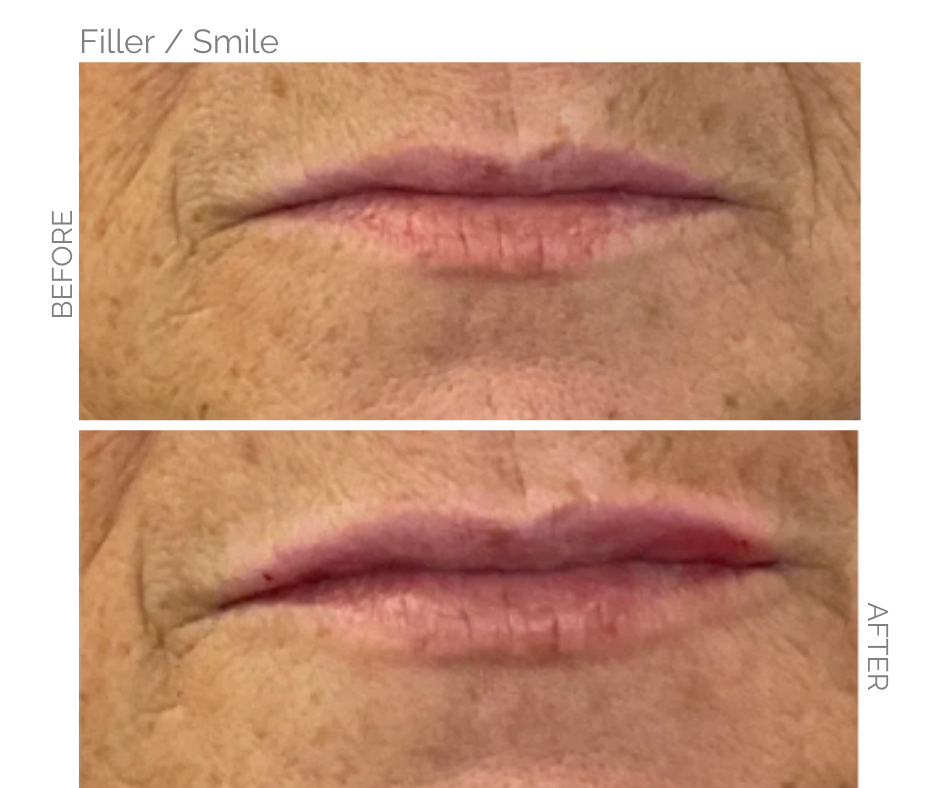 A very subtle lip fill to give a huge confidence boost