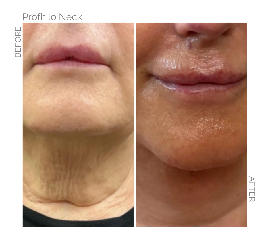Profhilo on the neck Before and After