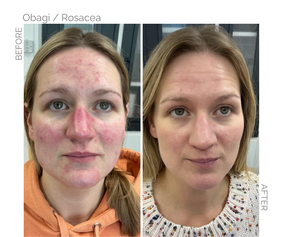 Before Obagi rosacea and after obagi