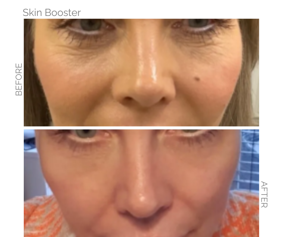 Skin booster used for uner eyes