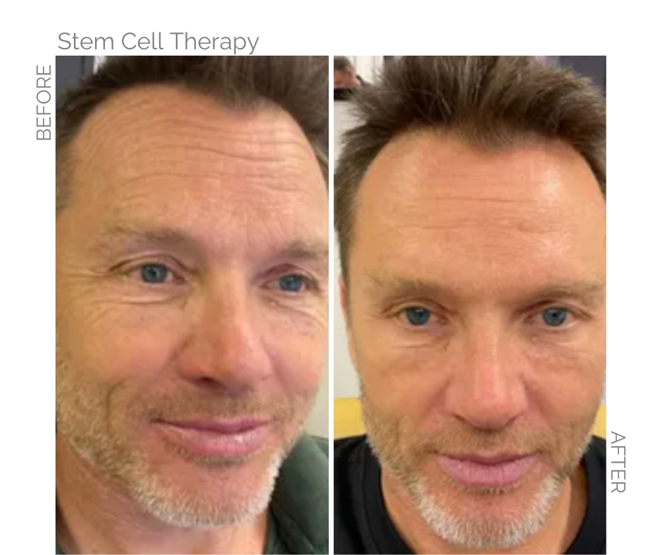 Norwich man before and after stem cell therapy