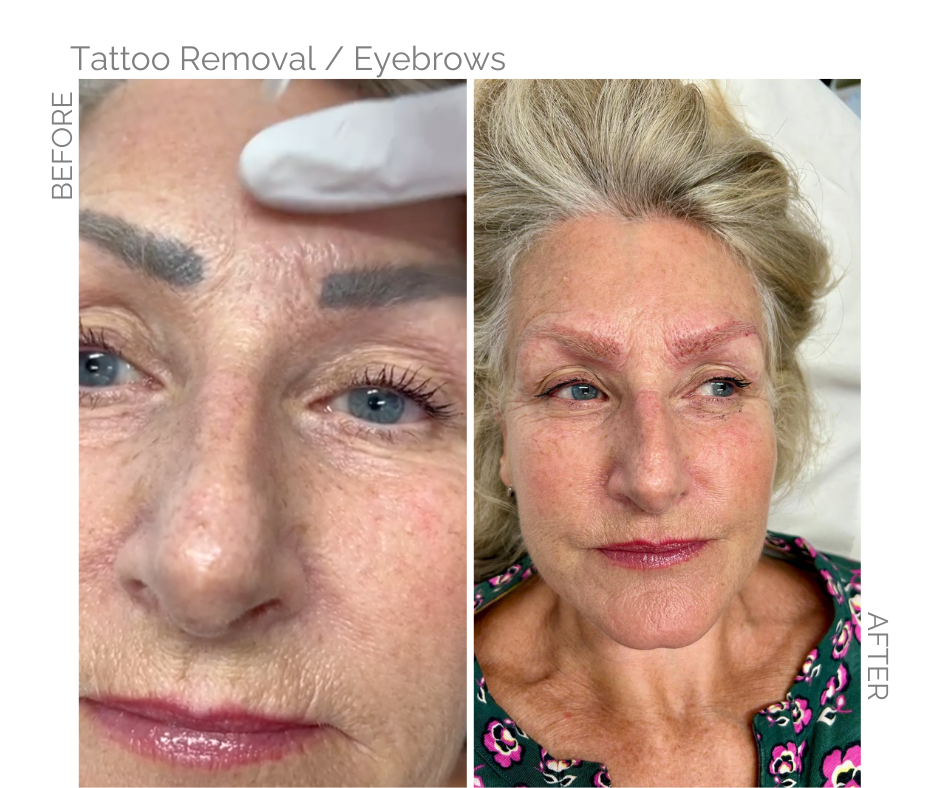 Badly Tatooed eyebrows removed by laser therapy Before and after pictures