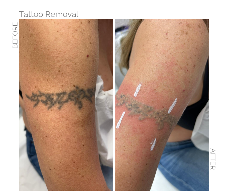 Tattoo removal with laser