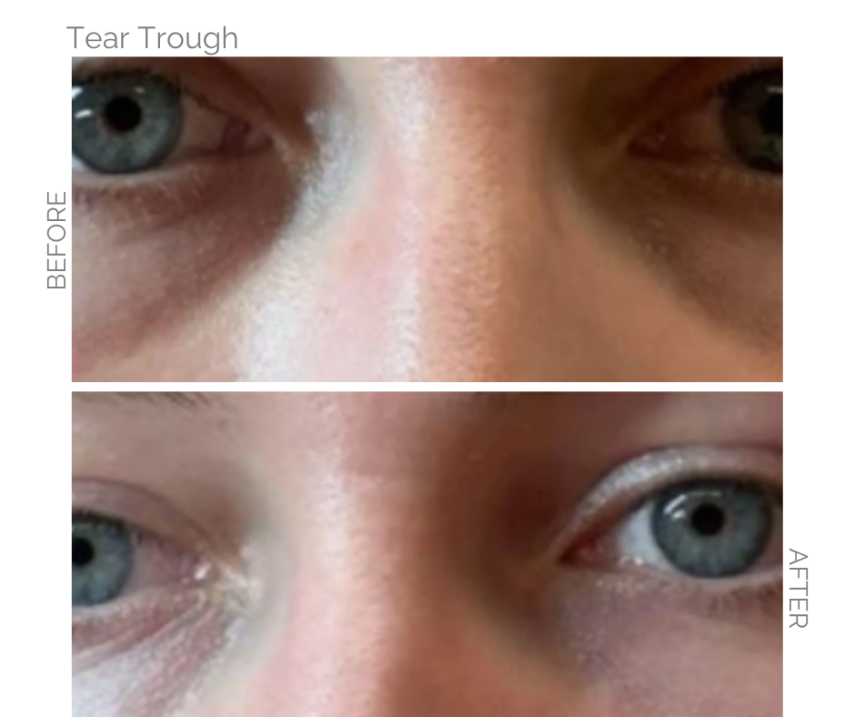 Tear Trough Treatment completed here is before and after