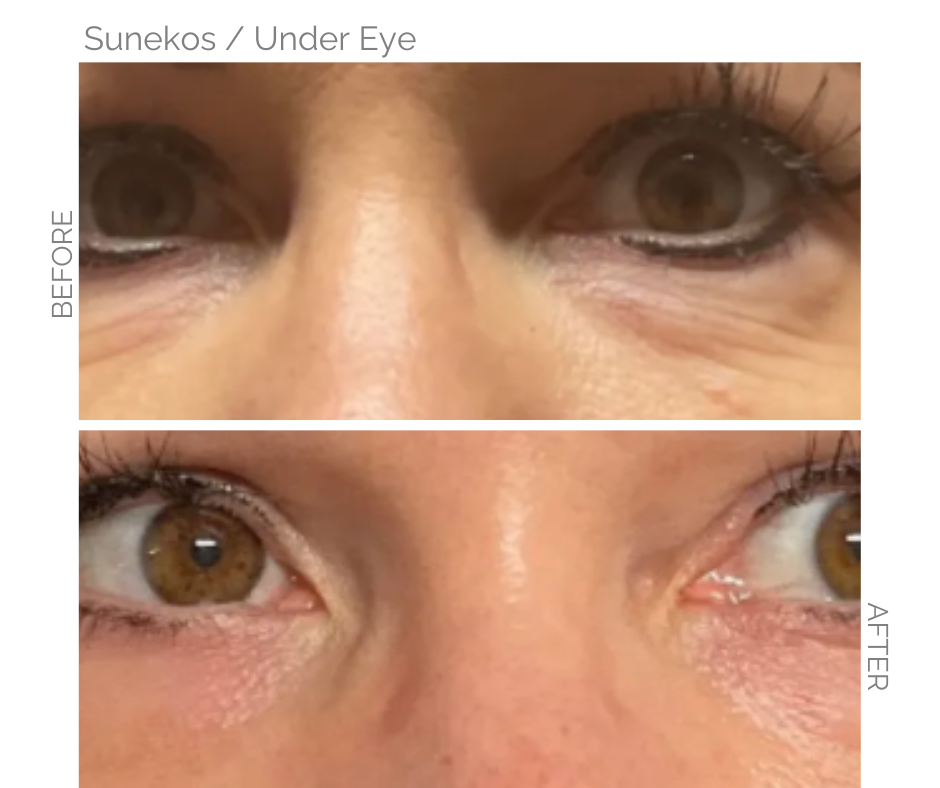 Under eye treatment with Sunekos