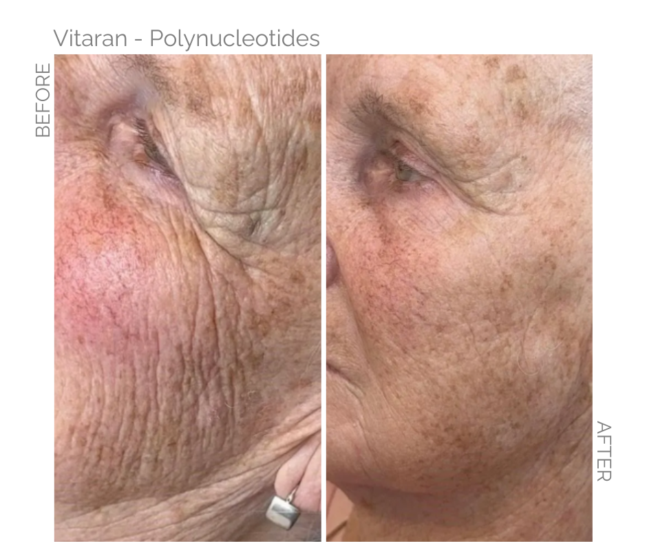 Comparison of a face before and after Vitaran polynucleotide treatment, showing reduced wrinkles and improved skin tone.