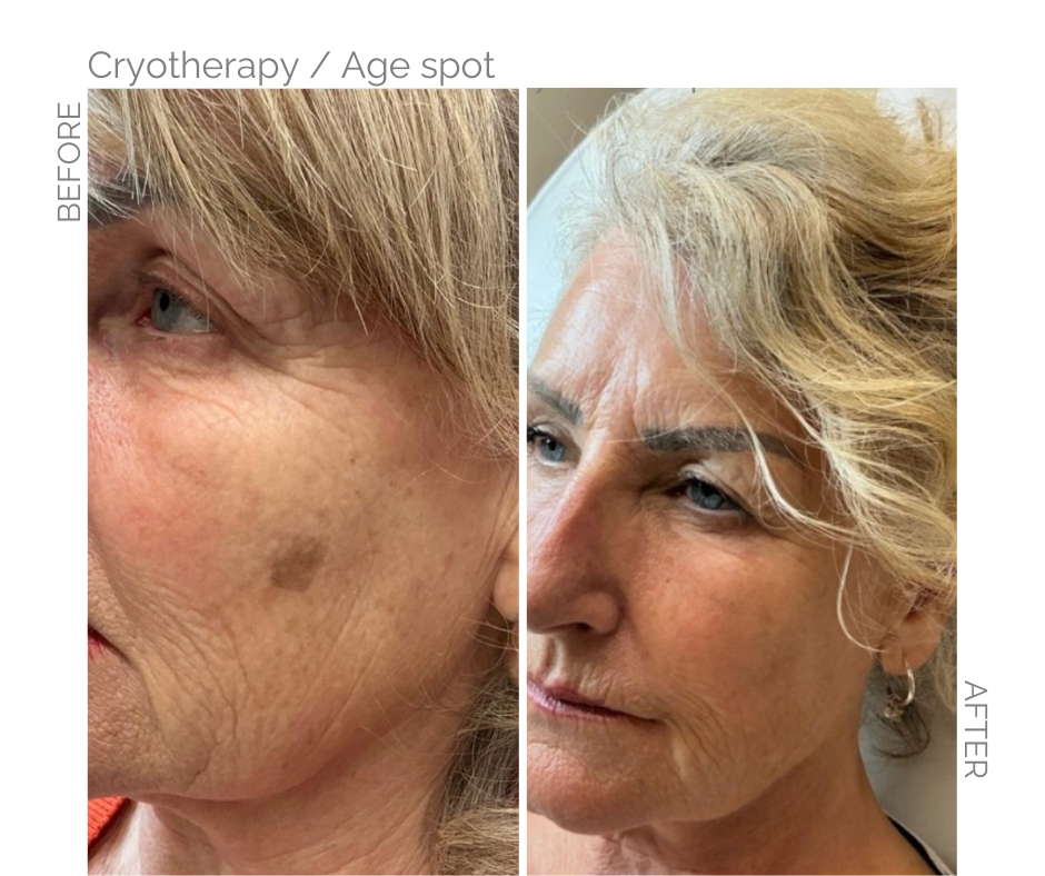 Age spot removed by Cryotherapy in Norwich Before and After pictures