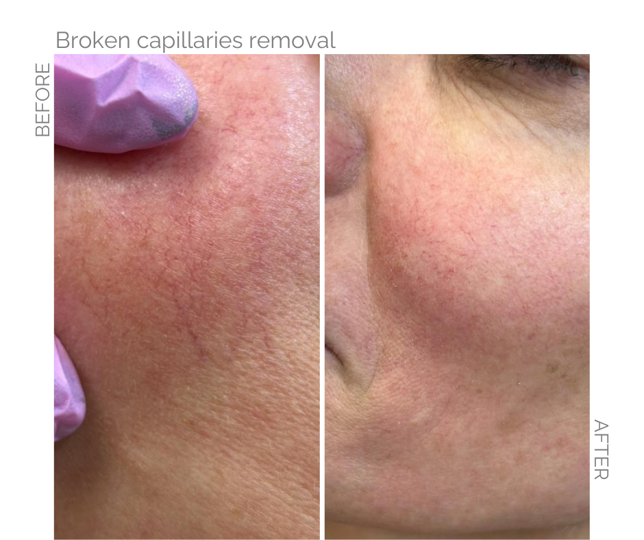 Broken capillaries on the cheek of Norwich lady and after electrolysis 