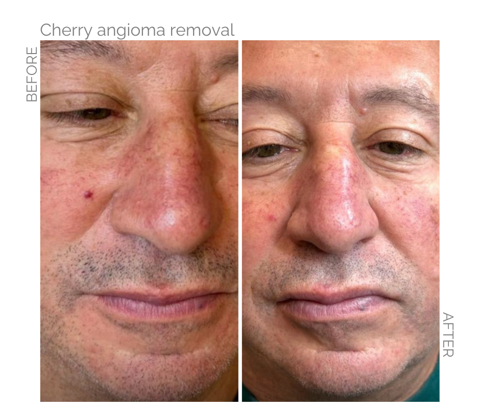 cherry angioma, a small, harmless red growth on the man's face and after treatment of electrolysis