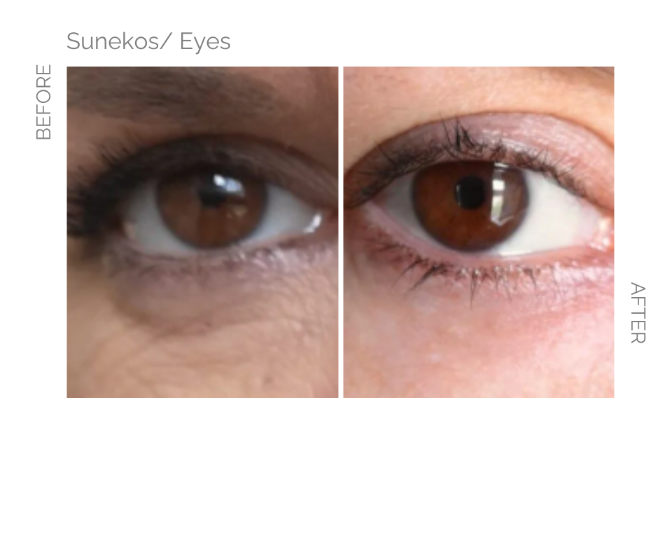 Sunekos treatment on the under eye