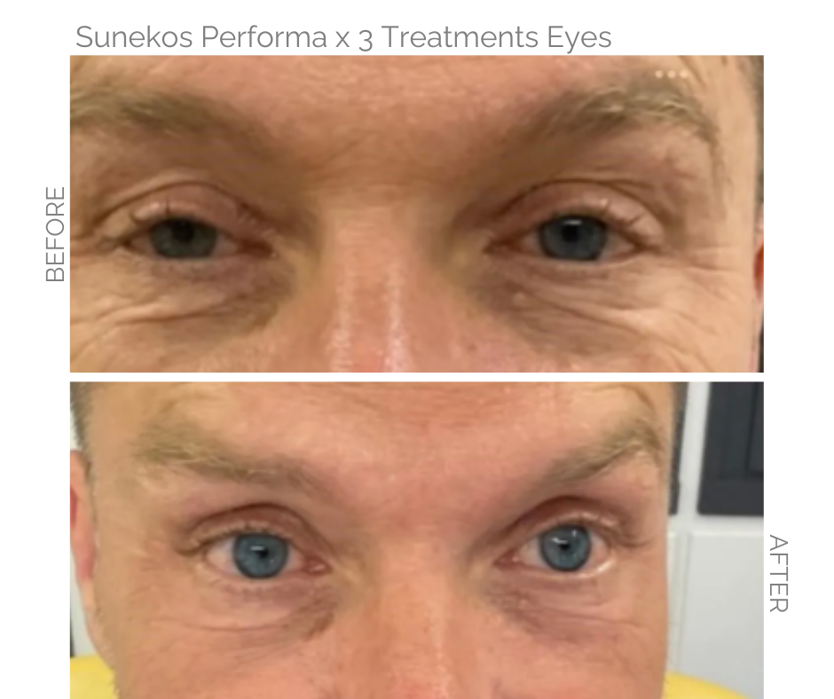 Sunekos Performa on the eyes Before and after