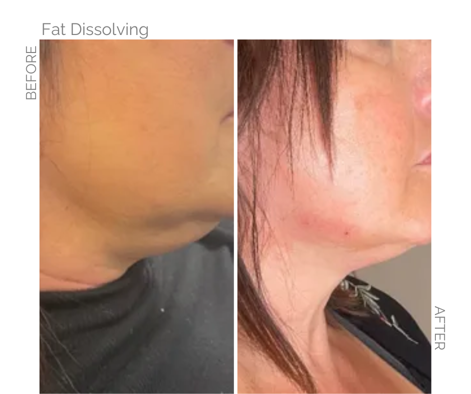 Norfolk lady before and after fat dissolve treatment on her chin