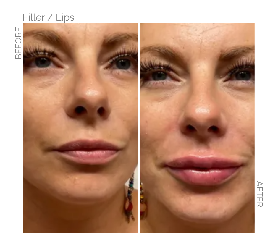 Lips before without filler and lips after with filler