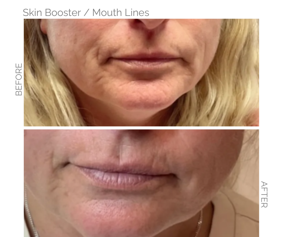 Bar lines also known as smokers lines before and after image when used skin booster