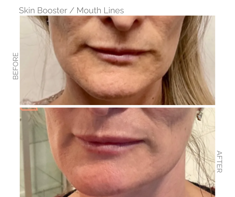 Skin booster used for smokers lines around the mouth