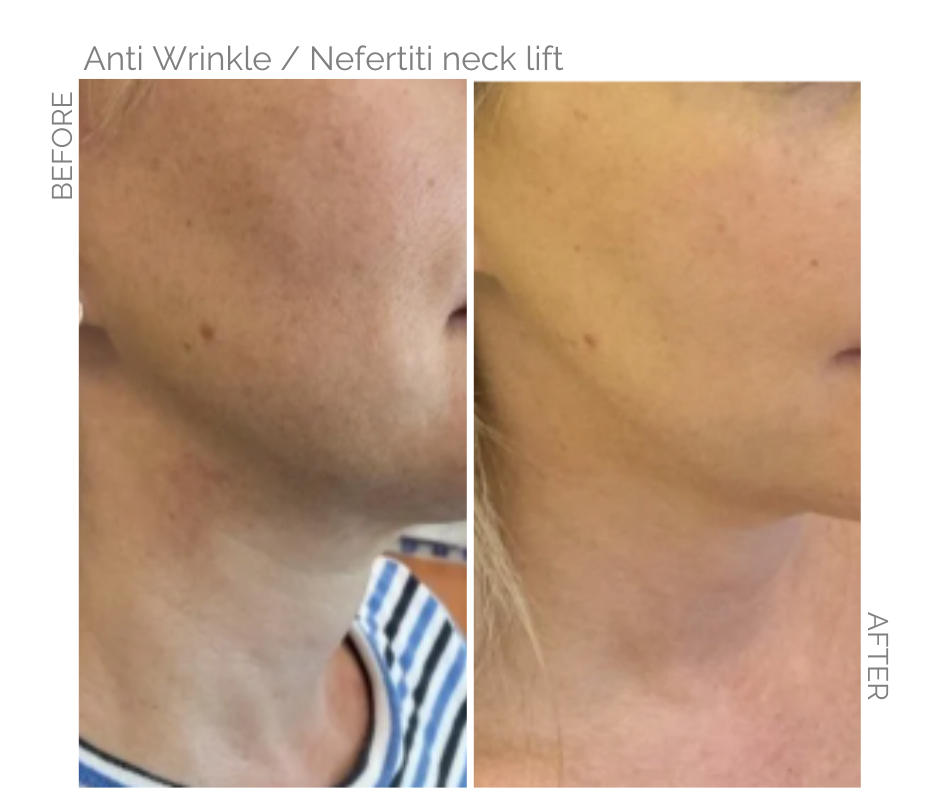 The Anti Wrinkle / Nefertiti neck lift procedure on this Norfolk lady