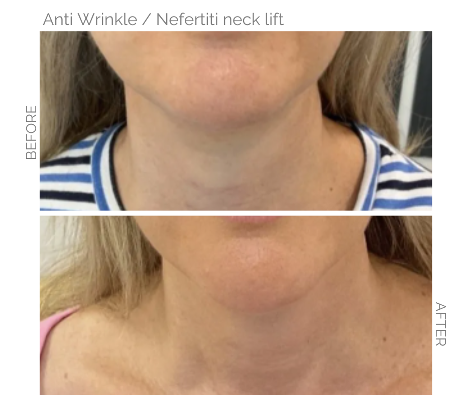 Anti wrinkle injections for a neck lift called a nefertiti neck lift