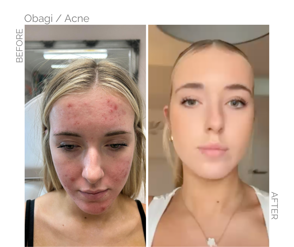 Acne before Obagi and the after Obagi use