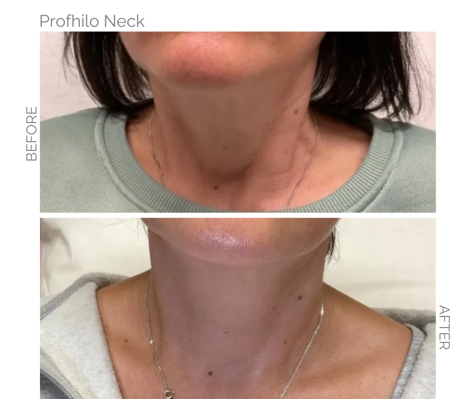 Before and After with Profhilo on the neck