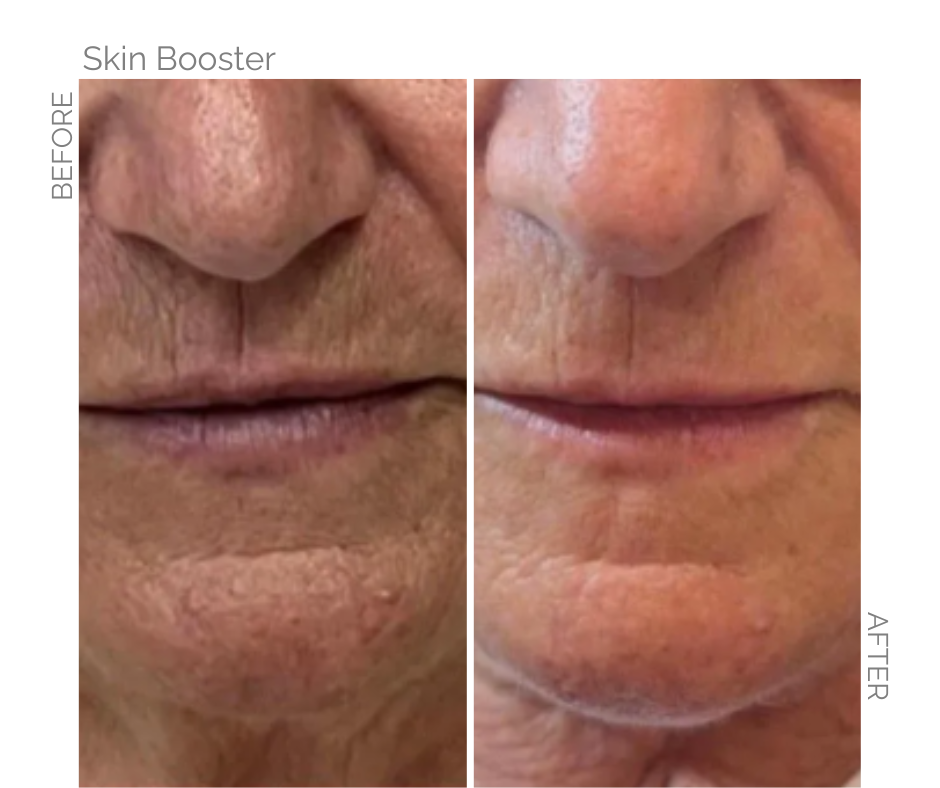 Skin booster for the face