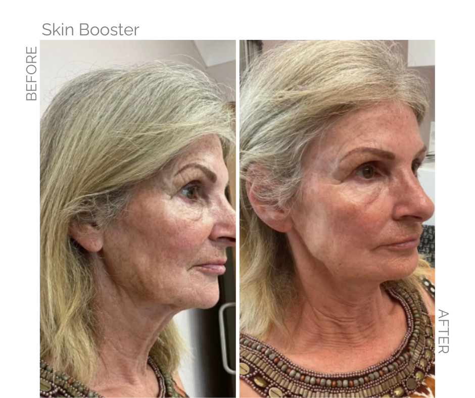 Skin Booster for face