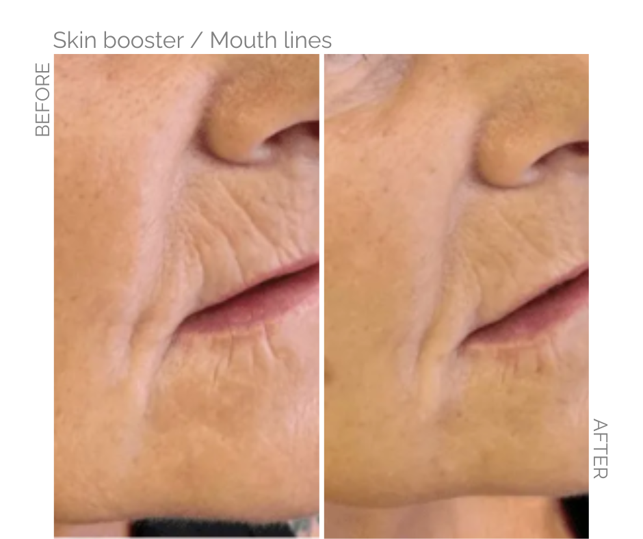 Smokers lines before and after skin booster
