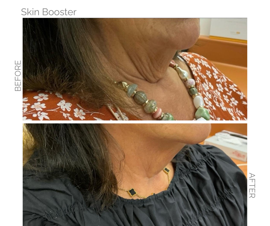 Before and after of neck with and without skin booster