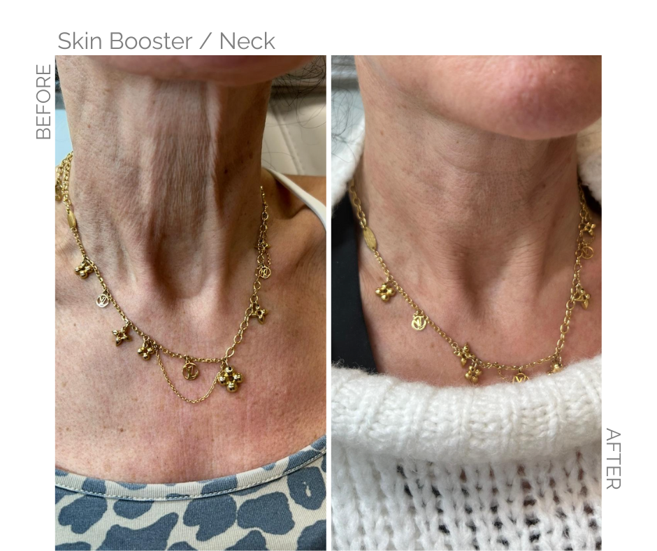 Comparison of a neck before and after a skin booster treatment.