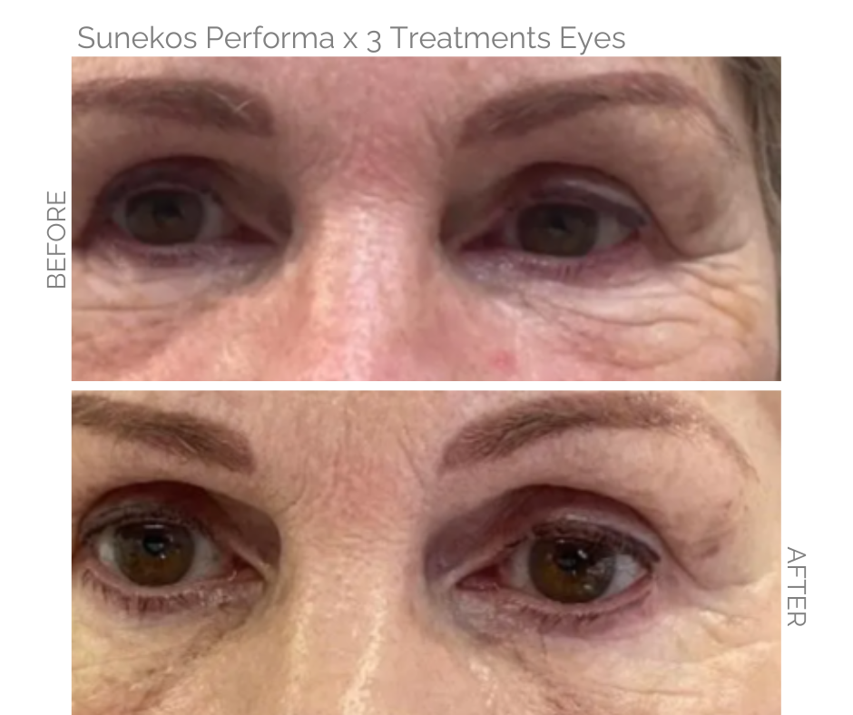 Sunekos on eyes before and after