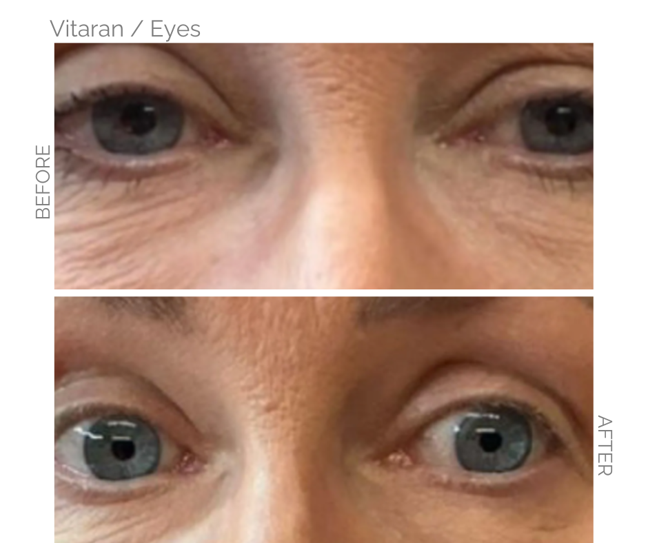 Vitaran on eyes before and after