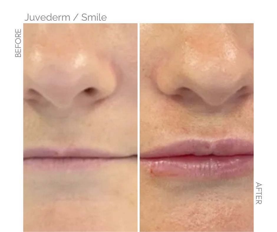 Juvèderm for lips smile