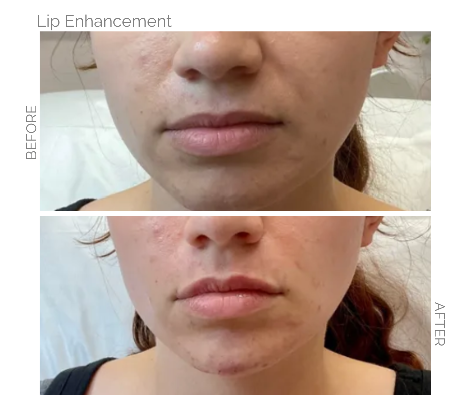 Comparison of woman's lips before and after lip enhancement. Top: Before. Bottom: After, fuller lips.