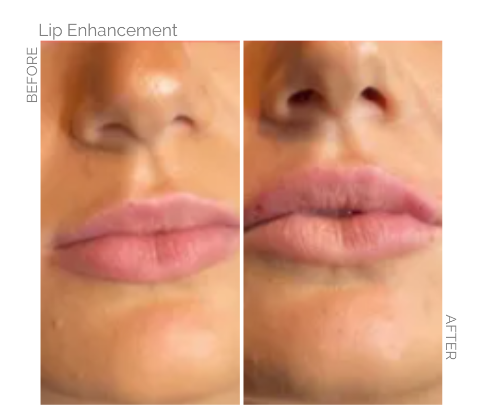 Side-by-side comparison of lips before and after lip enhancement, showing increased fullness and shape.