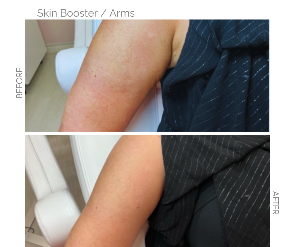 Skin Booster for Arms This is Right Arm before and After