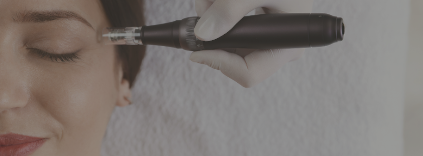 Microneedling lady in Norwich