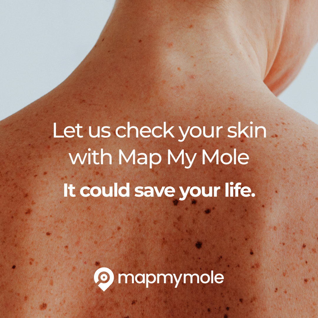 Map my Mole Skin check