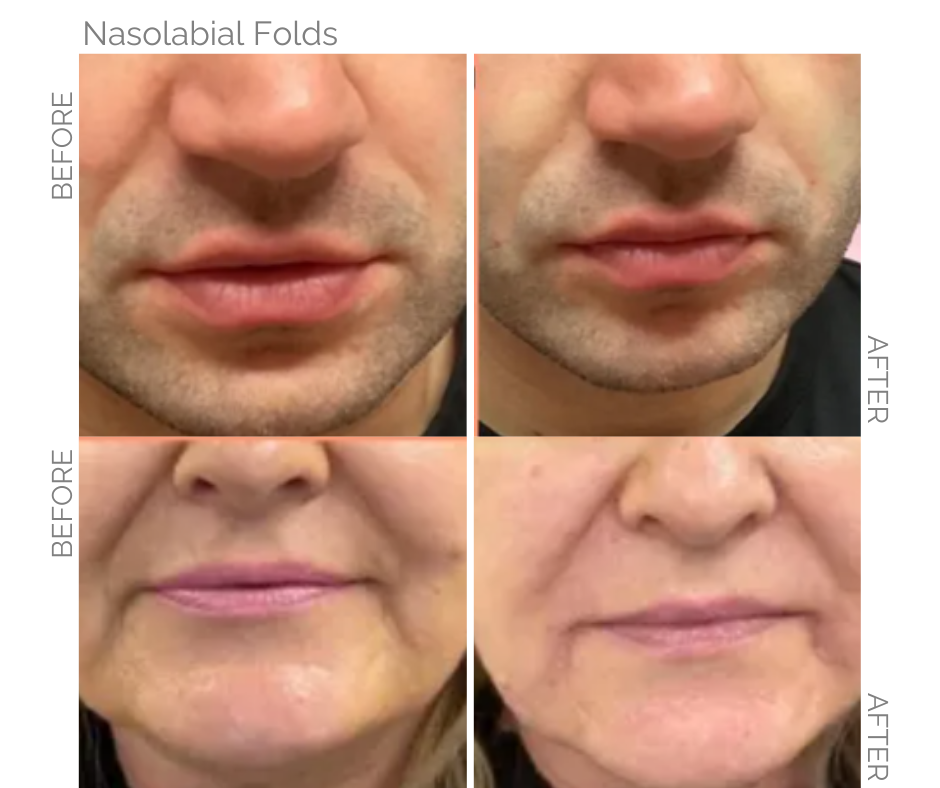 Nasolabial folds, or 