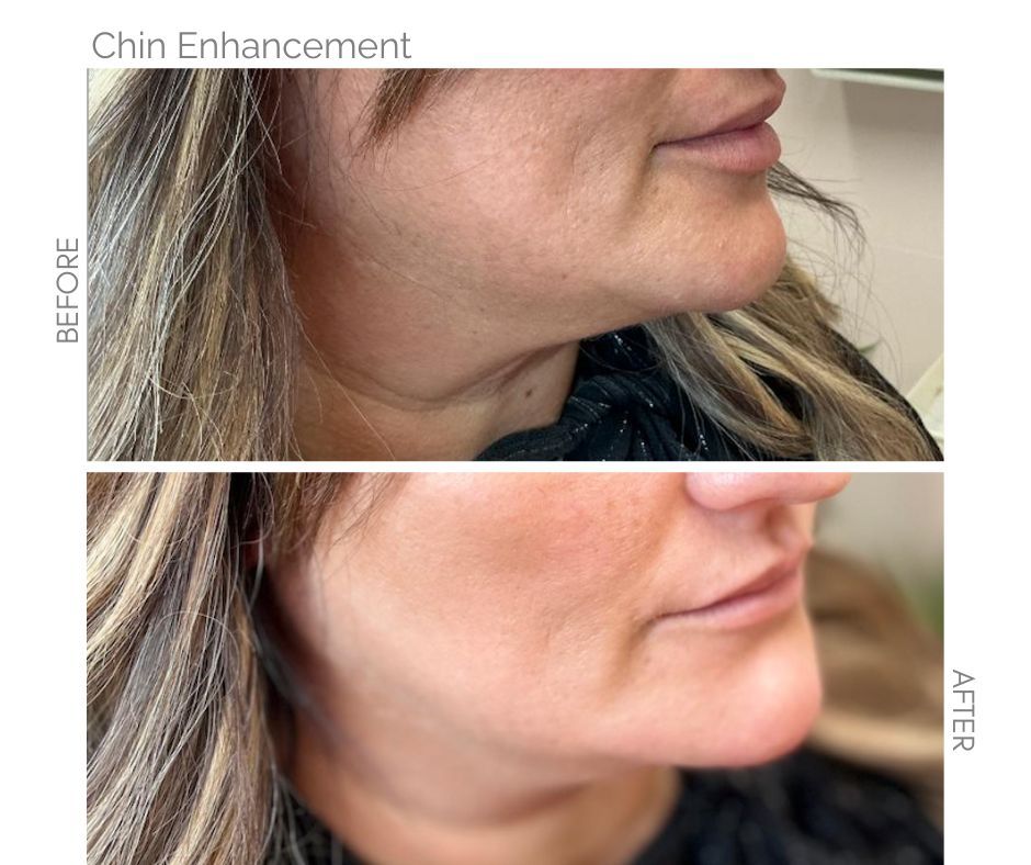 Chin enhancement with filler