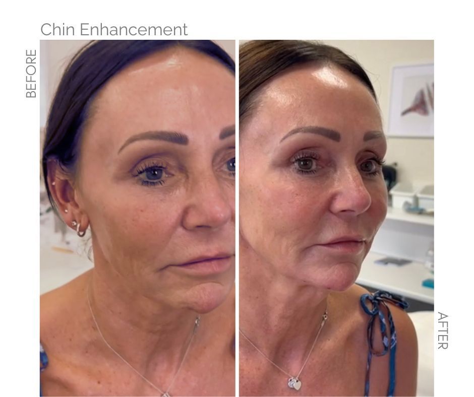 Chin enhancement on chin with filler