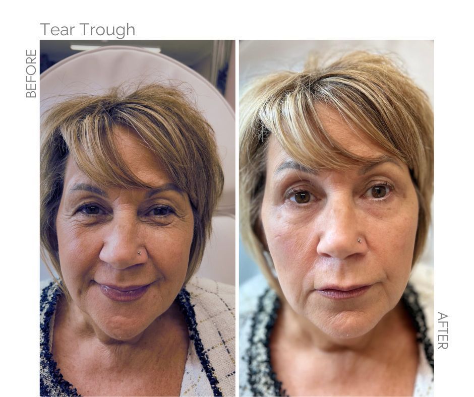 Tear Trough Before and After