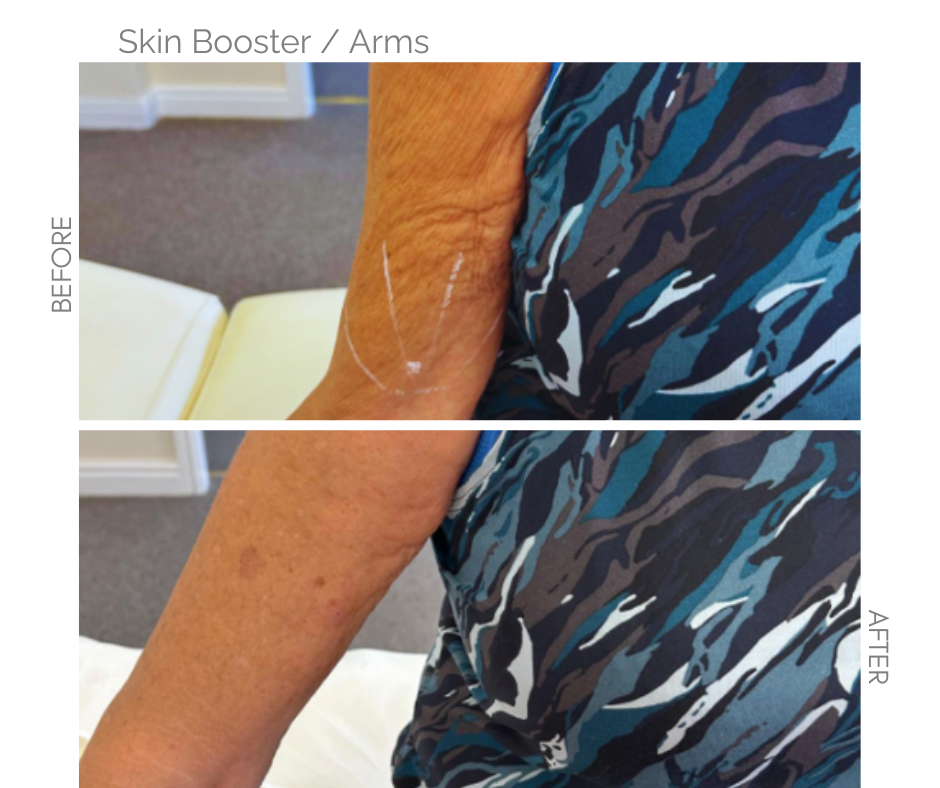 Before arm without skin booster and the same arm after skin booster.