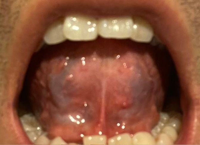 Close-up of a person's open mouth, showing a deep purple tongue and white teeth.