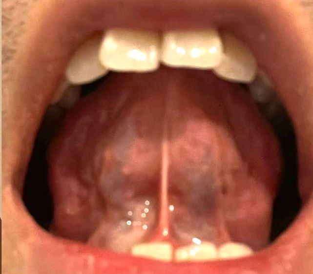 Inside of a mouth, showing tongue, teeth, and tissue. Tongue is slightly blue, with the frenulum visible.