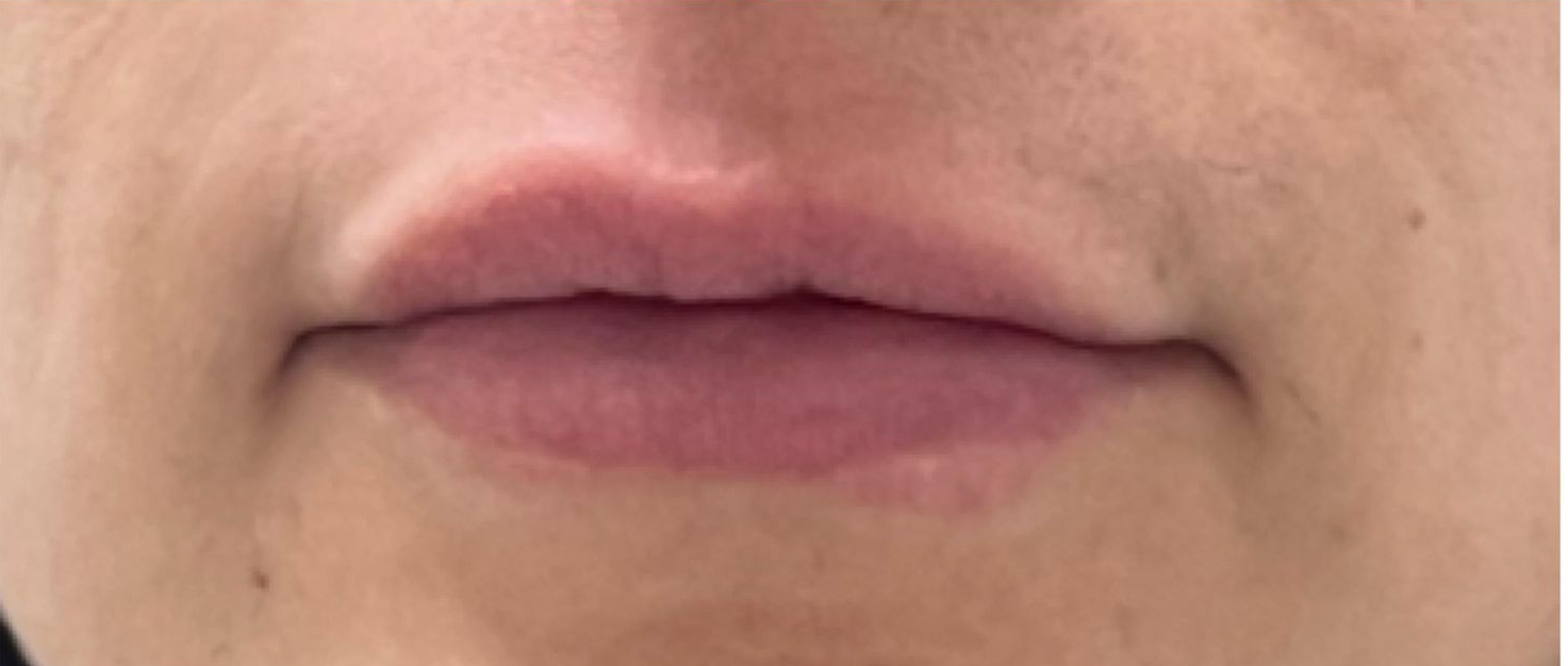 Close-up of a person's face, focusing on the lips, nose, and chin. Skin is fair.