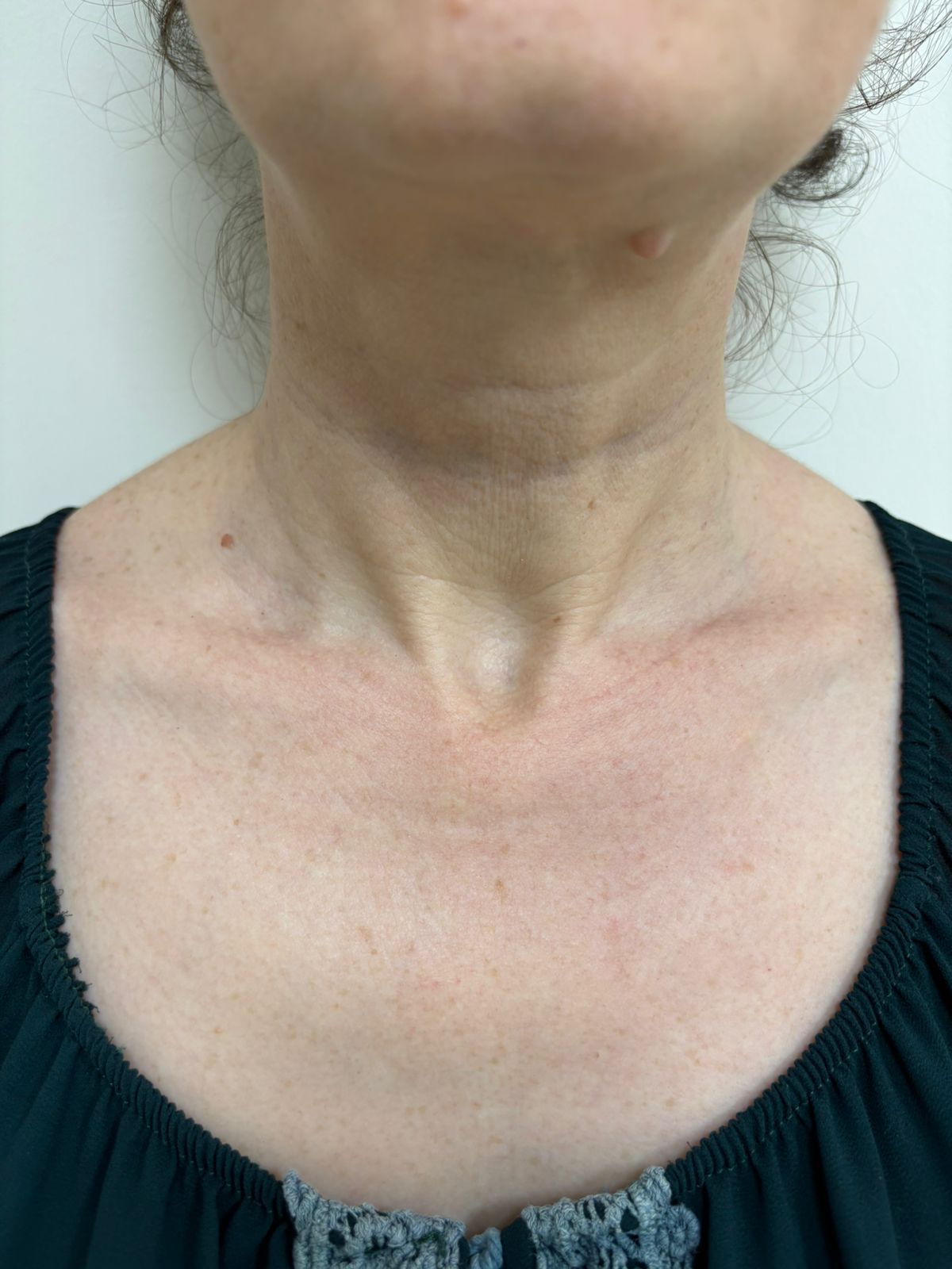 Upper torso of a person, showing neck and chest with visible wrinkles.